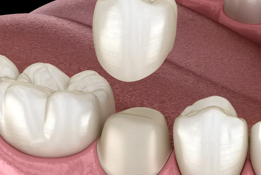 dental crowns