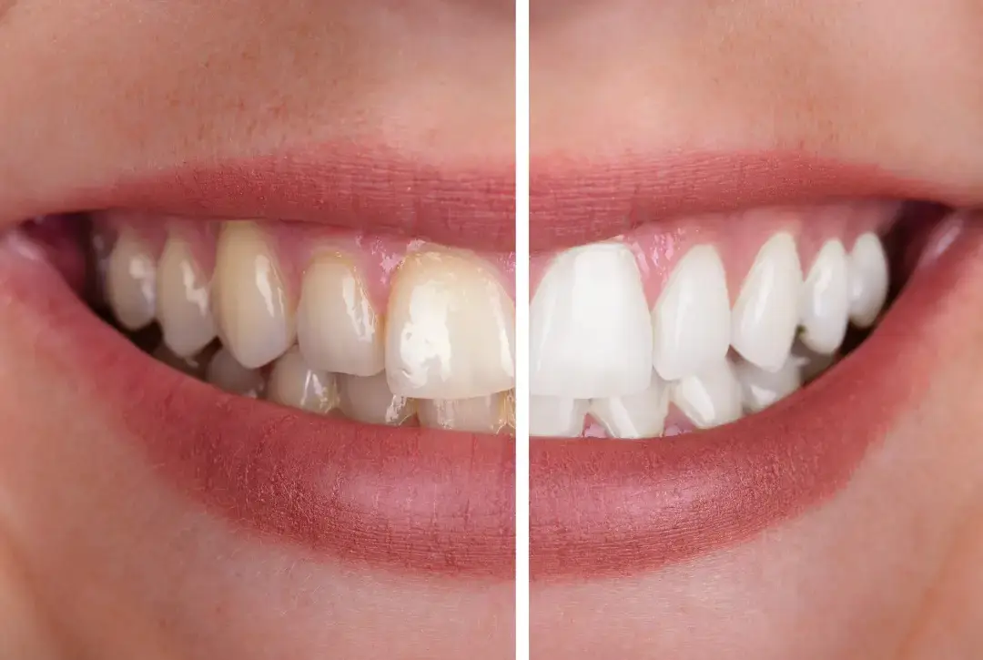 teeth whitening