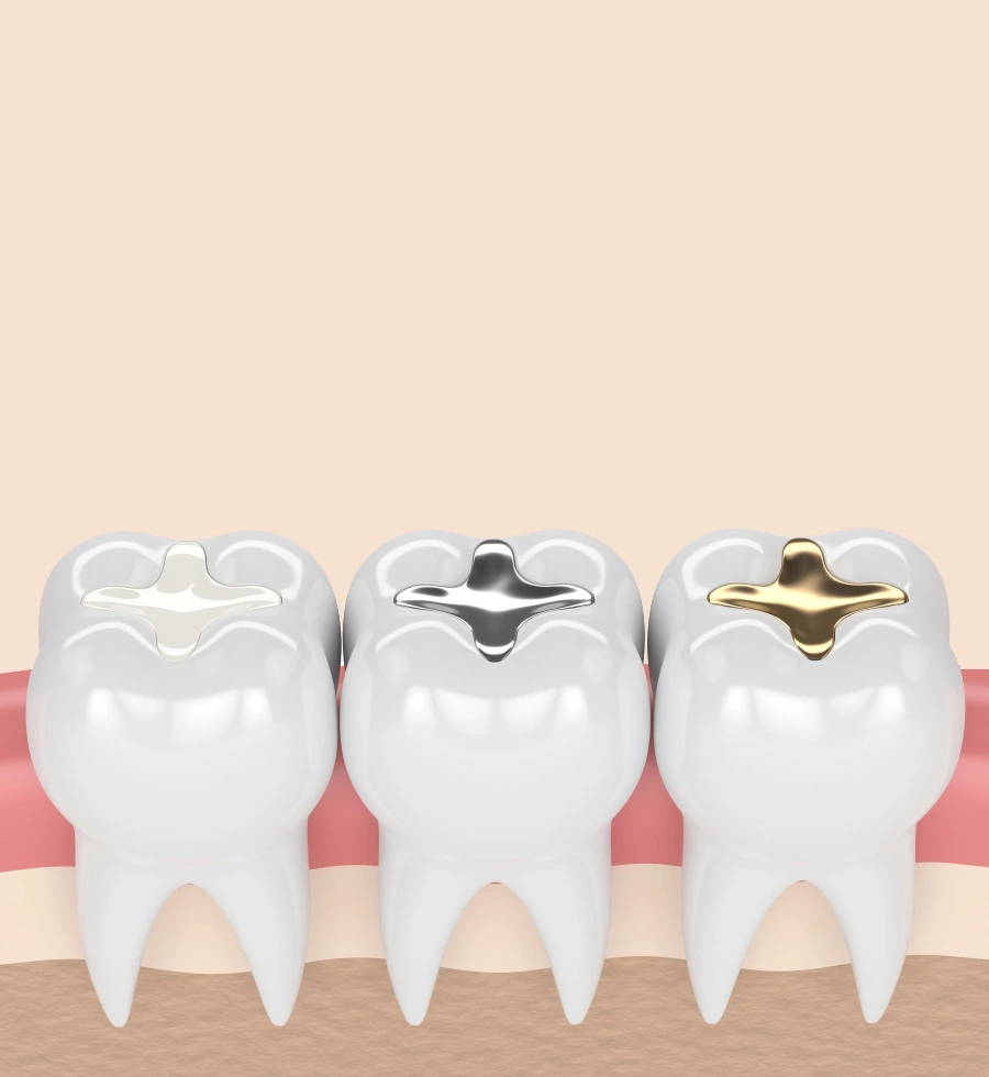 Dental Fillings