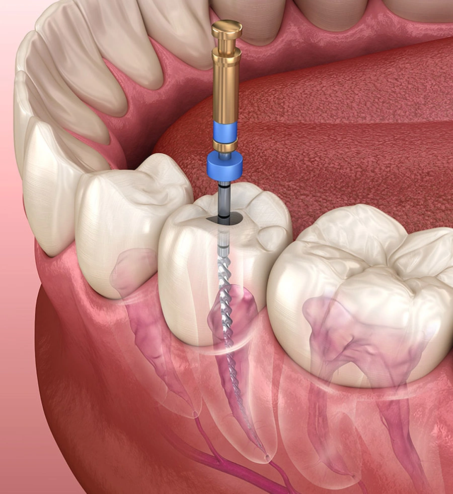 Root Canal Treatment